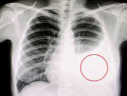 apa la plamani imagini radiografie