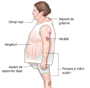sindromul cushing poze: simptome