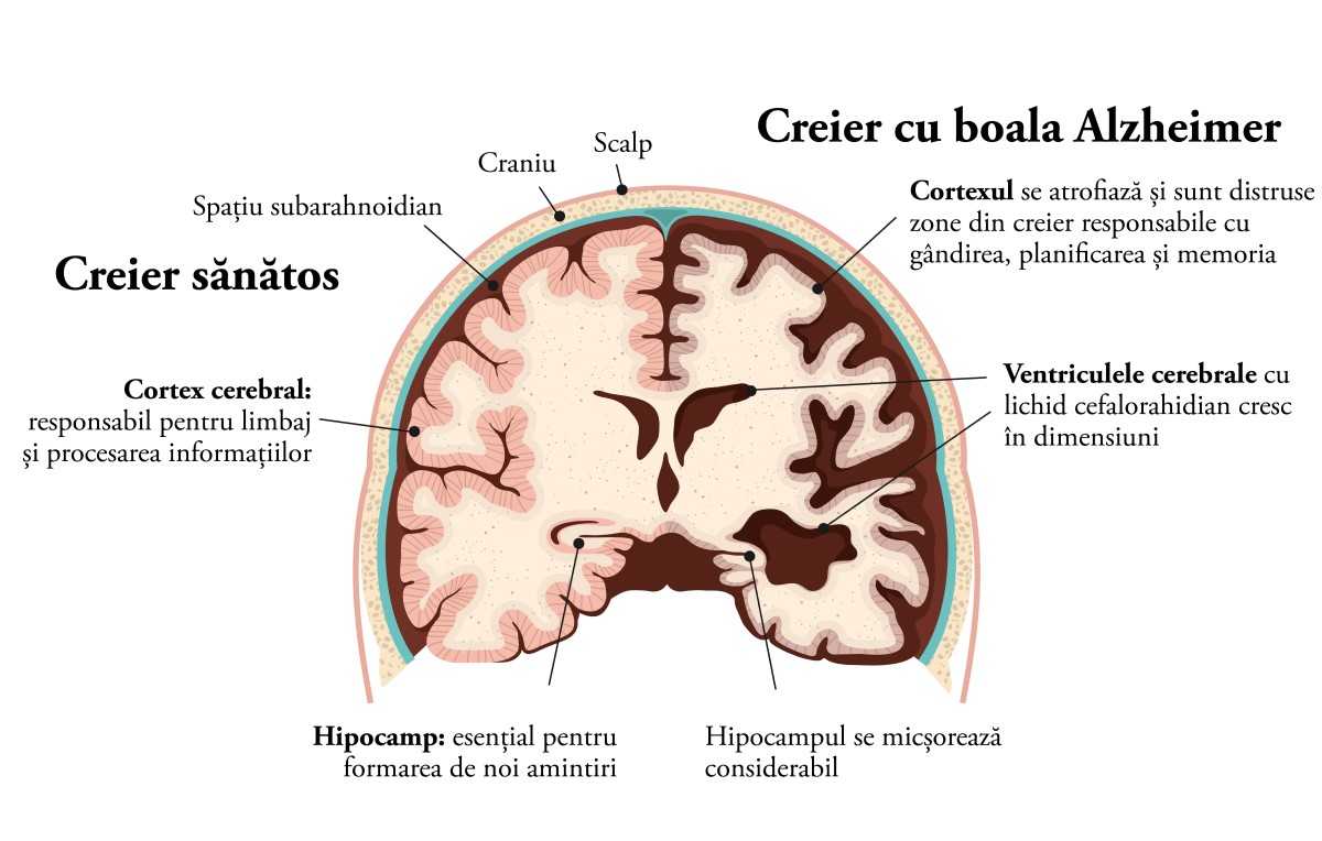 boala alzheimer. creierul se atrofiaza si sunt afectate tot mai multe zone