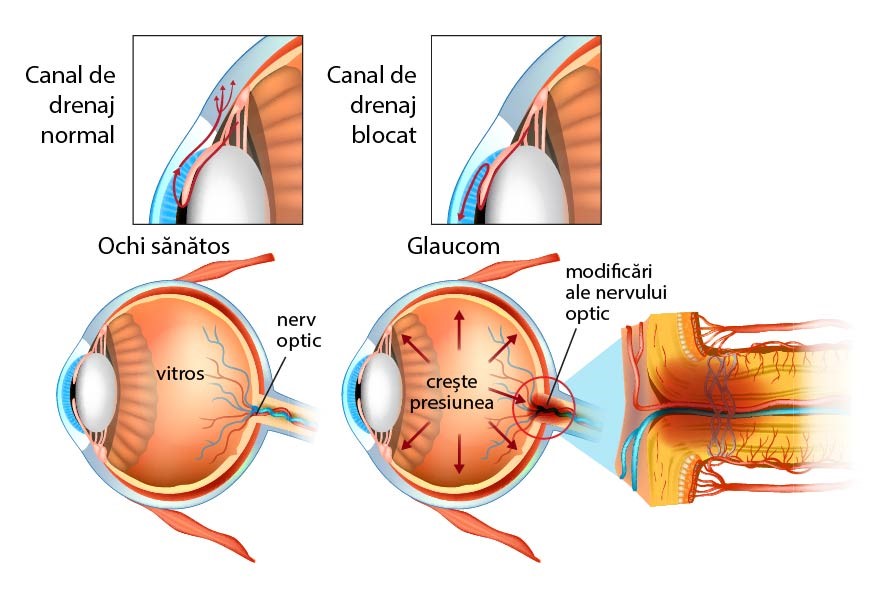glaucom anatomia ochiului