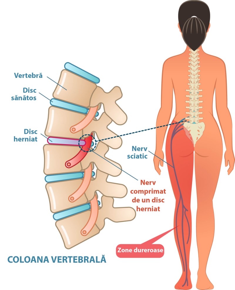 nervul sciatic poze anatomie