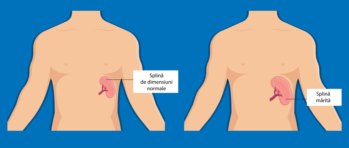 splenomegalie. splina marita de doua ori