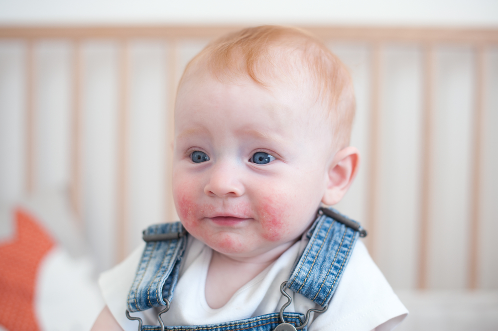 alergii ale pielii poze dermatita atopica