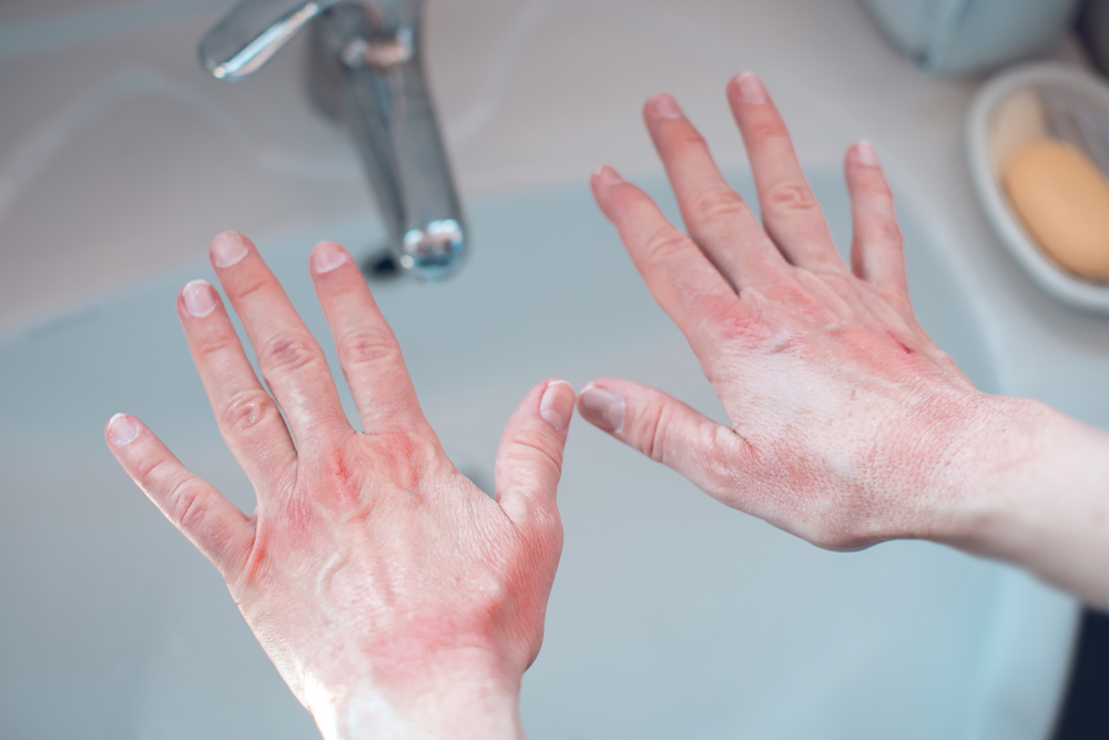 alergii ale pielii poze dermatita de contact