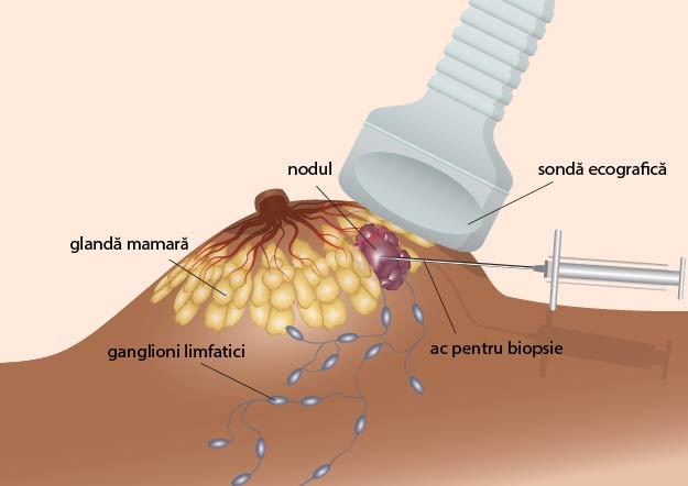 biopsie san cu ac fin