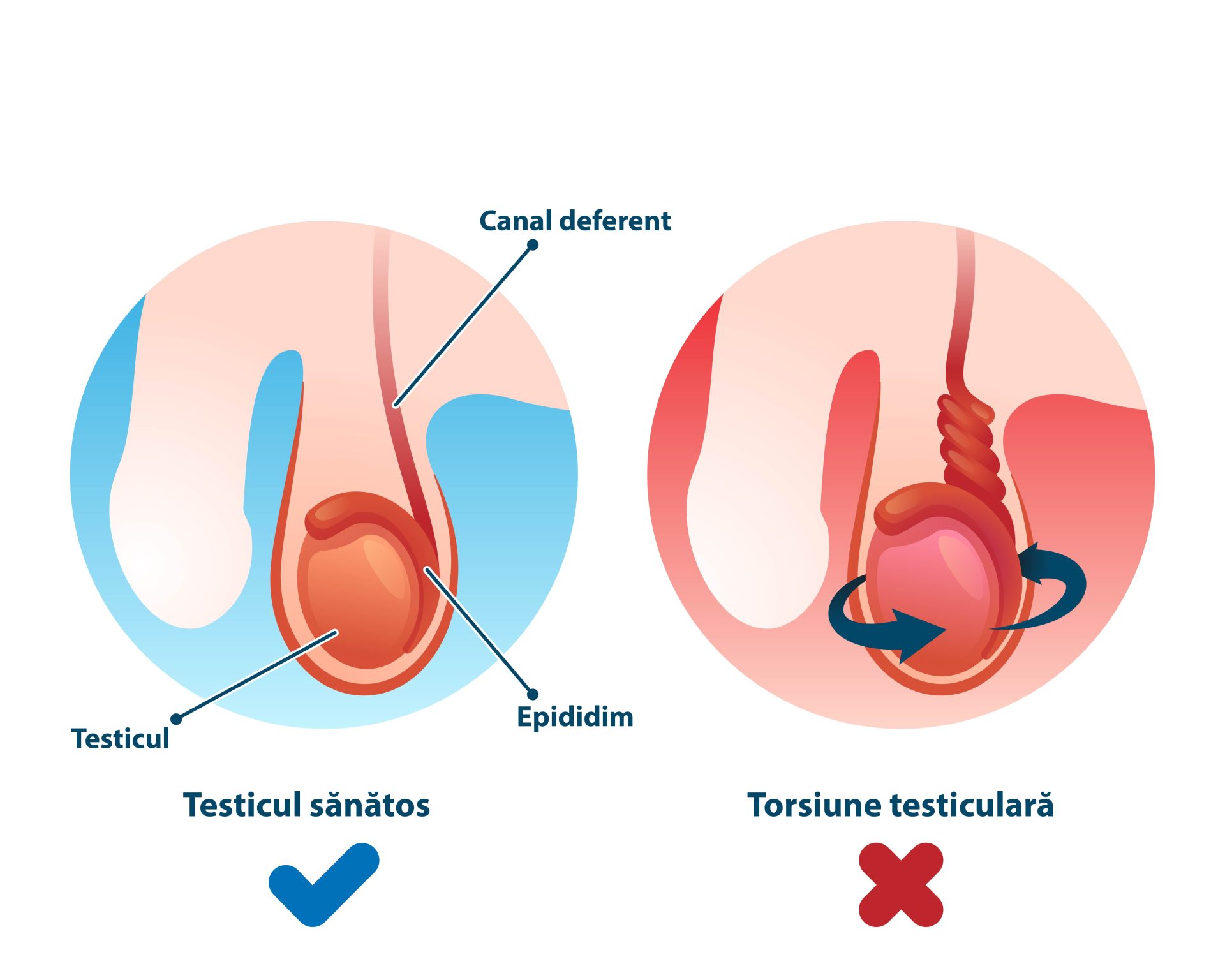 durere de testicule. cum arată o torsiune de testicul