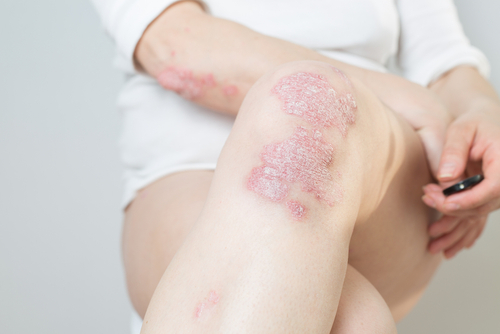 iritații ale pielii psoriazis genunchi