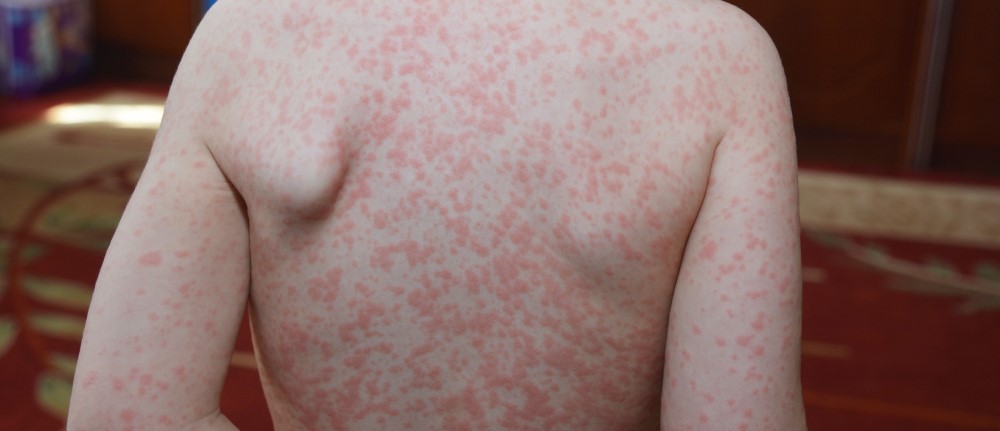 mononucleoza infecțioasă poze