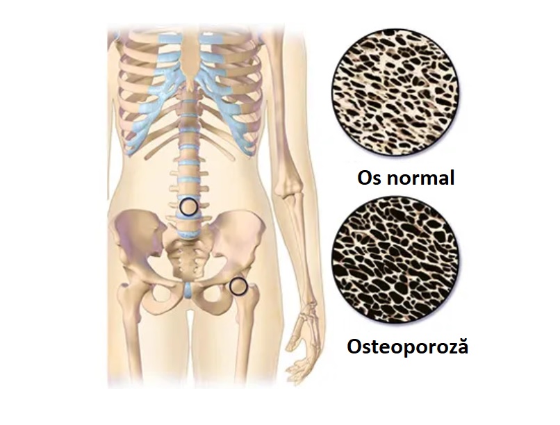 osteopenie-si-osteoporoza-pierderea-densitatii-osoase