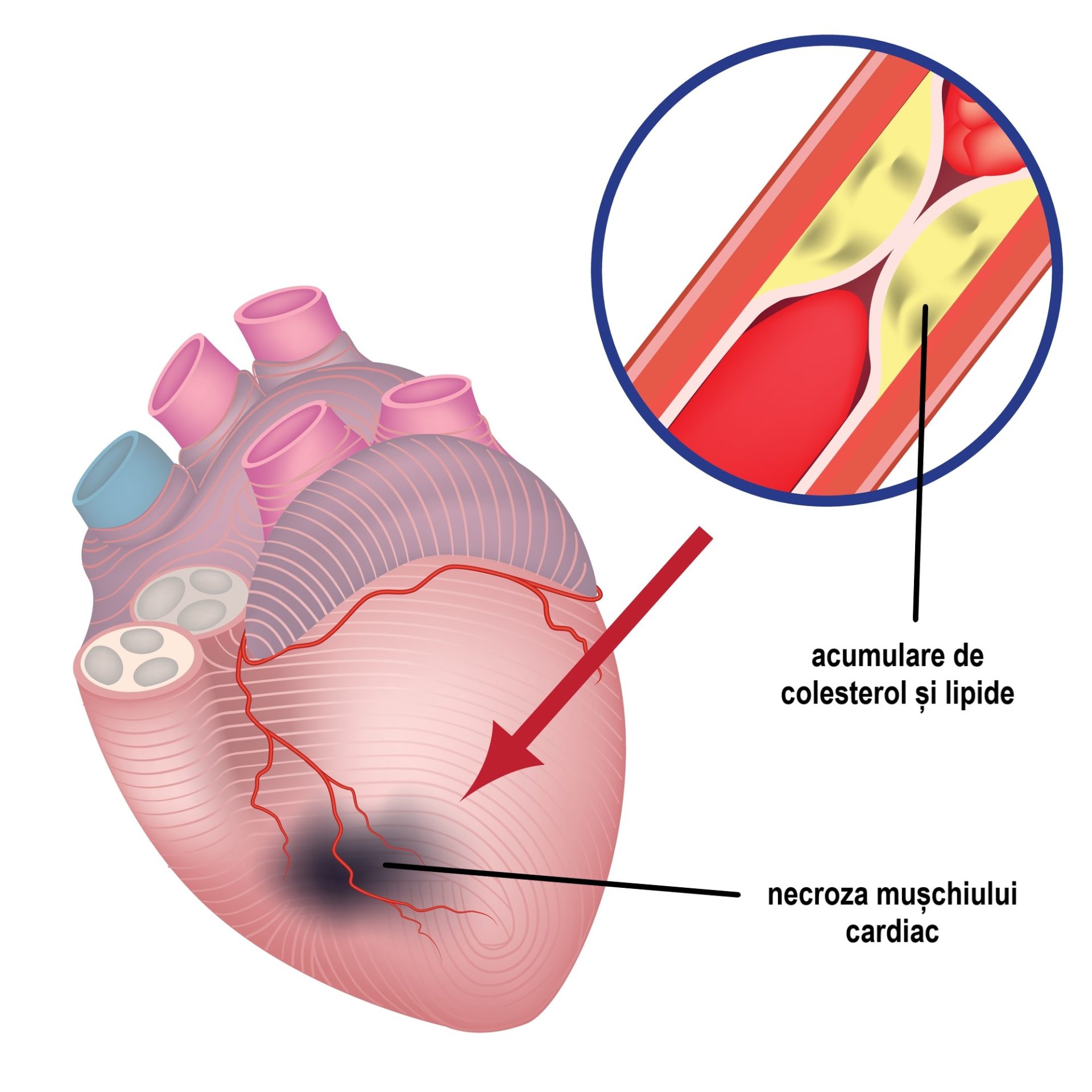 Cum apare un infarct miocardic