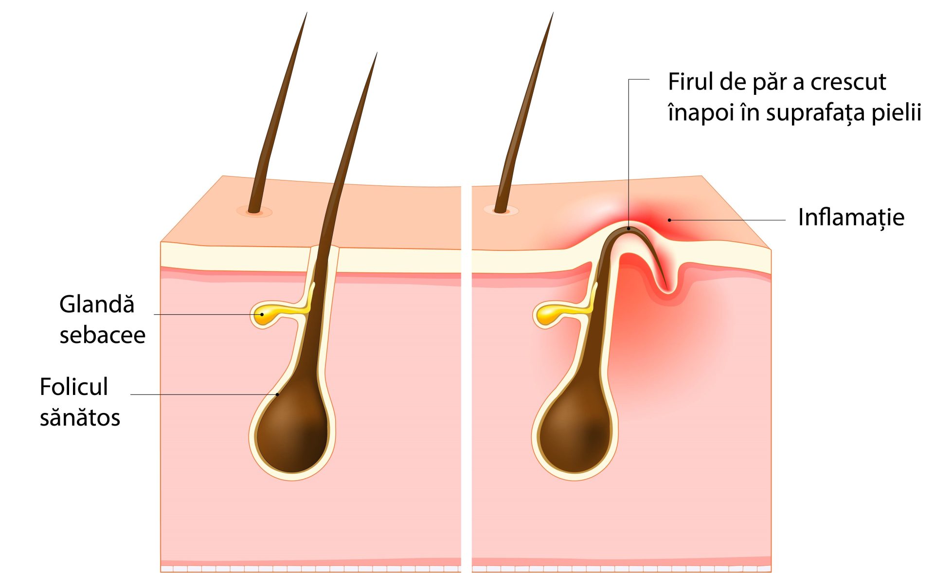 foliculita e diferita de firele crescute sub piele
