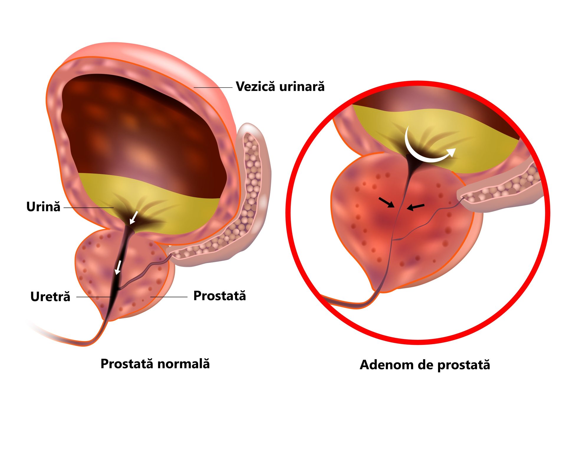 Prostată normală și adenom de prostată