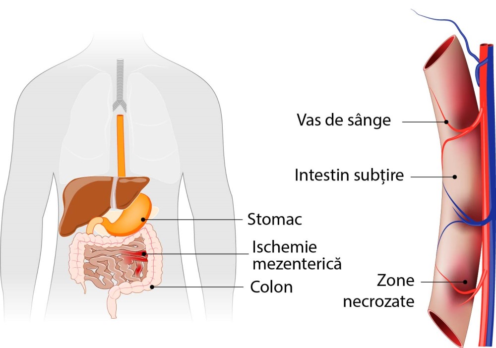 infarct mezenteric, schema