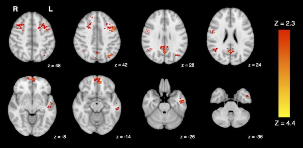 poluarea în trafic și efectul asupra creierului, vizibil pe fMRI