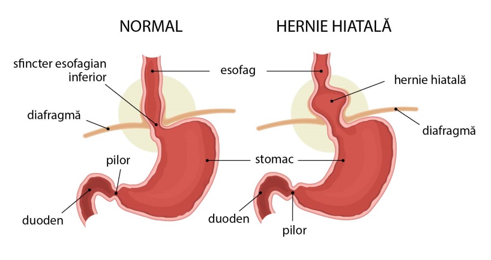 hernie hiatală