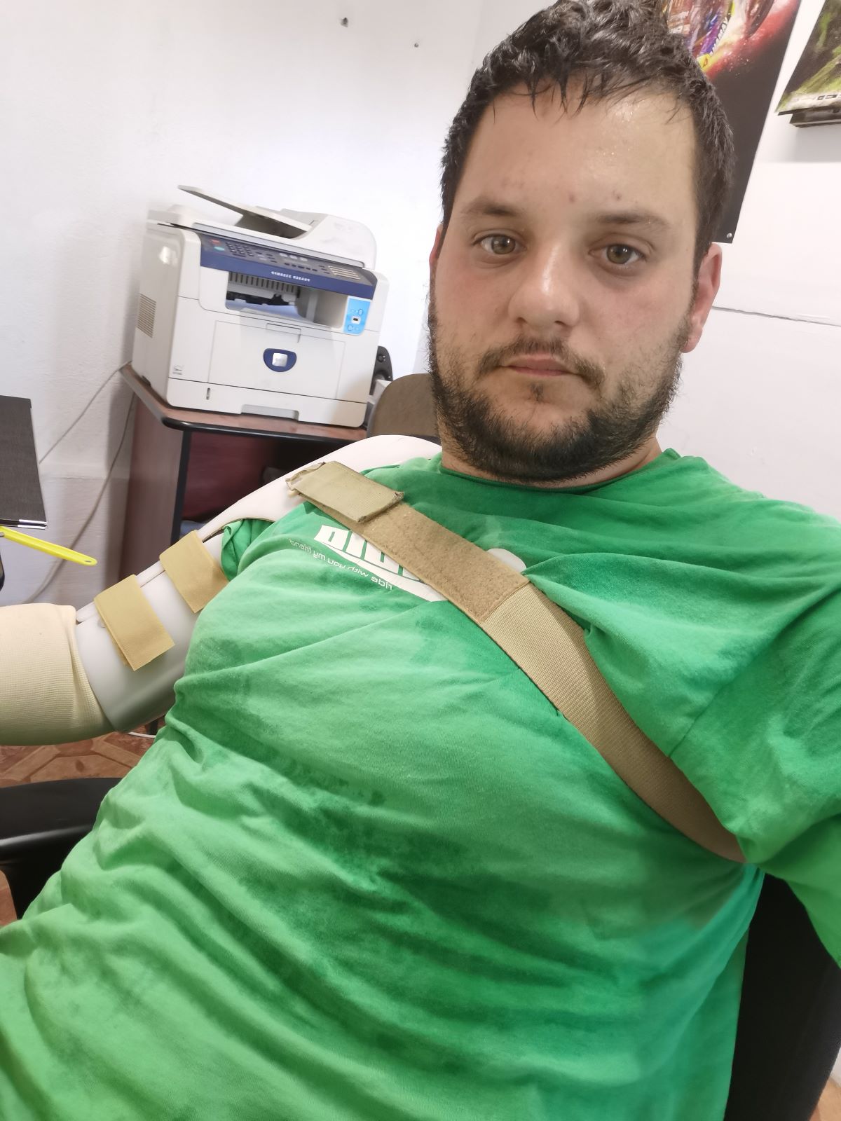 operat pentru fractură de humerus