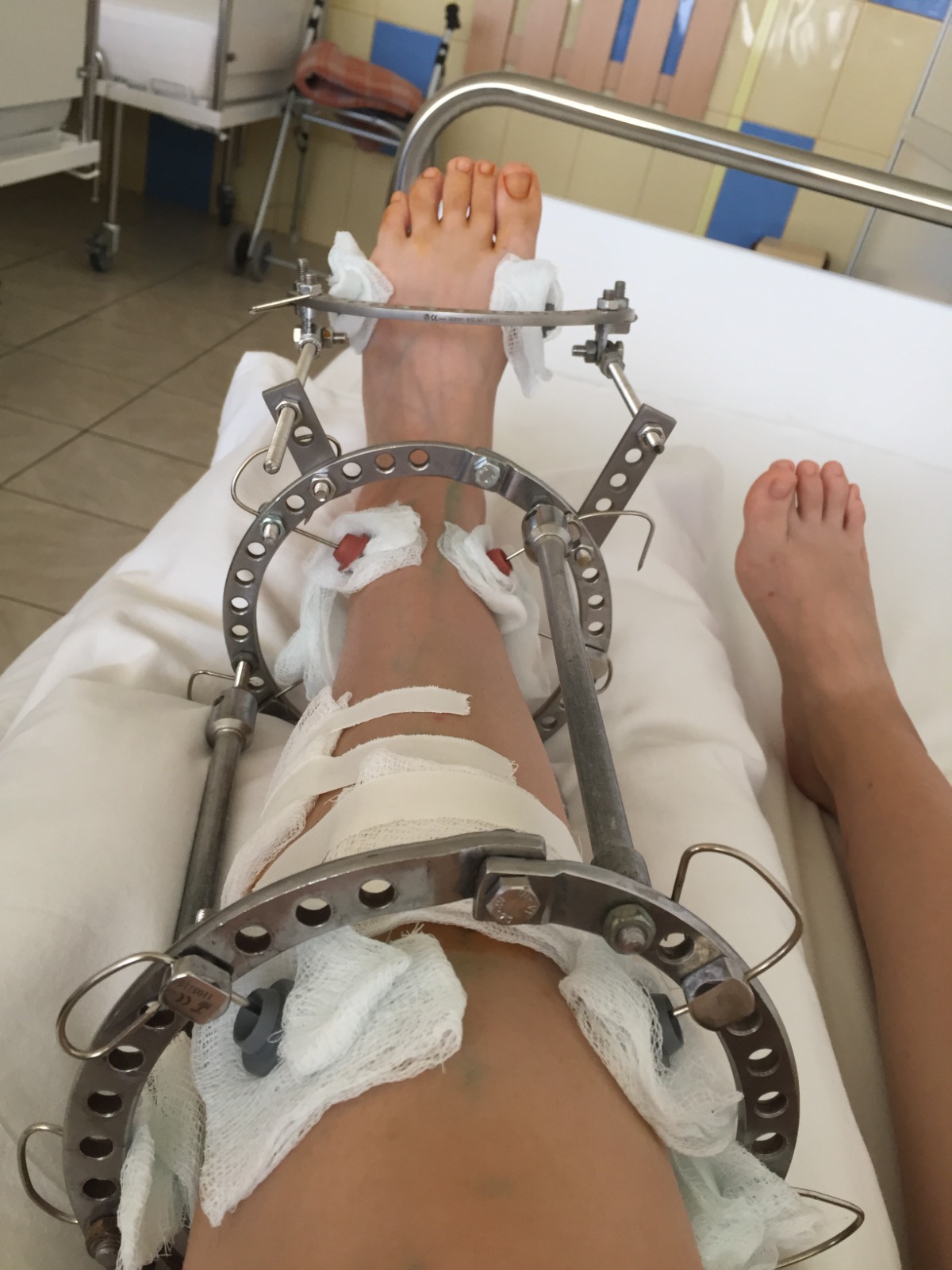 parapareză spastică fixator Ilizarov