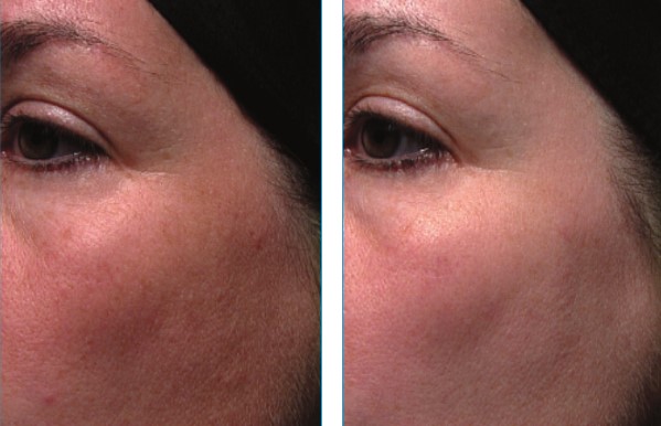 fotografii înainte și după - o femeie care a folosit zilnic niacinamide 5% timp de 12 săptămâni