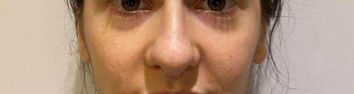 efecte rinoplastie