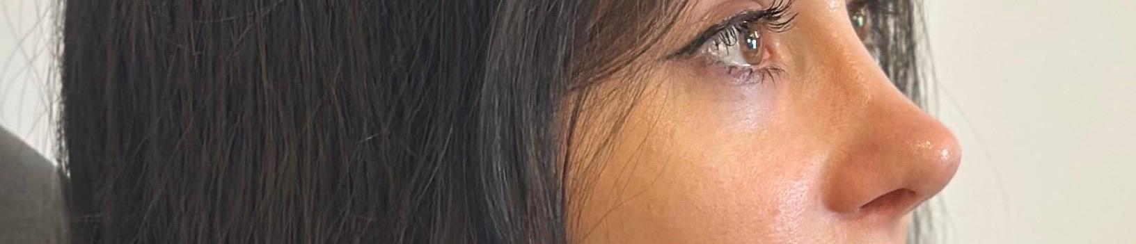 rinoplastie operatie