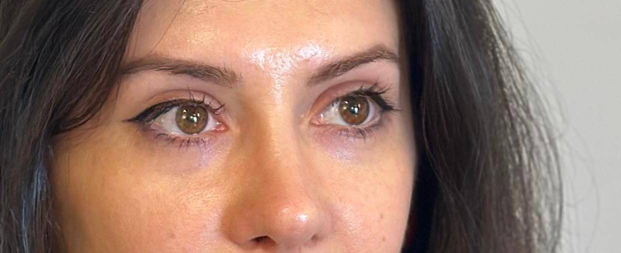 rinoplastie