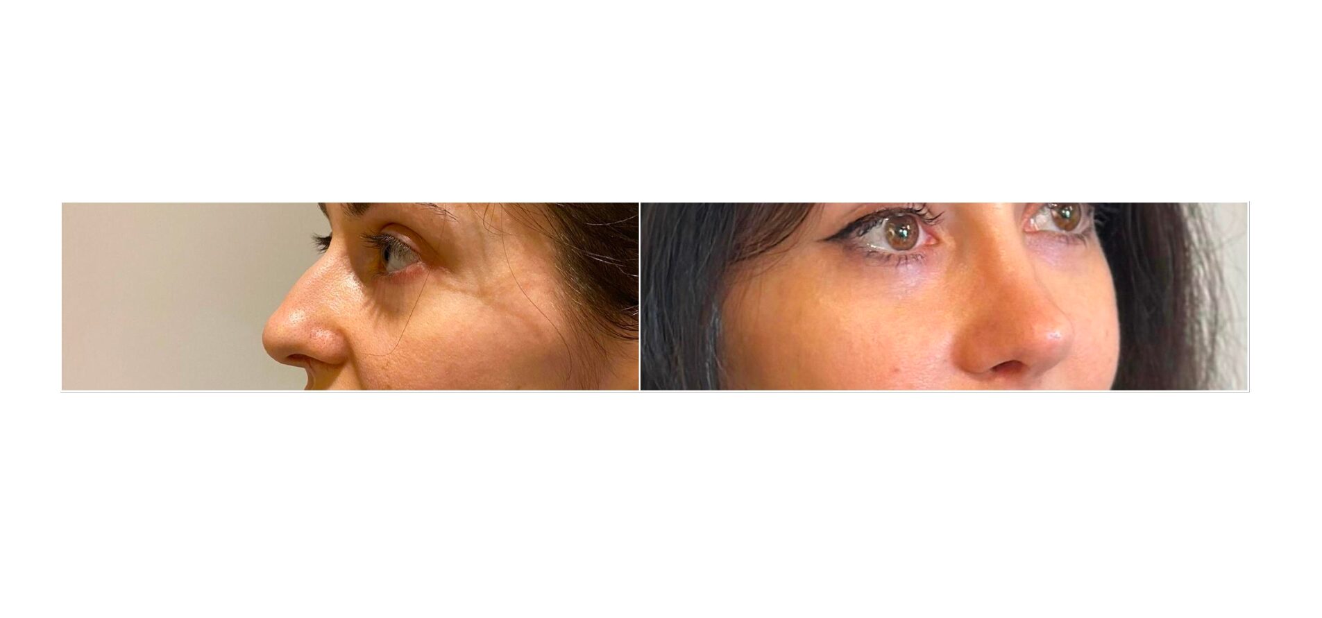 rinoplastie