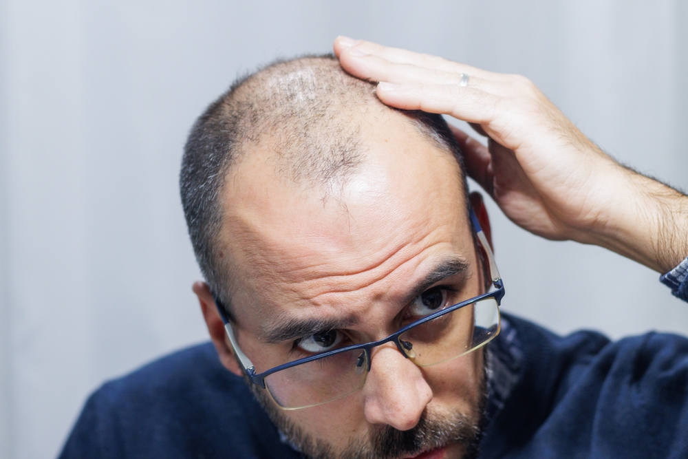 bărbat cu o imagine corporală negativă din cauza faptului că vede în oglindă că chelește