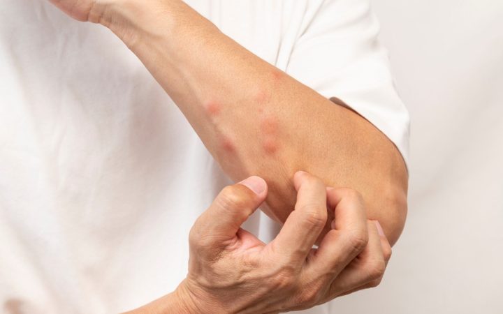 bărbat cu înțepături de țânțar care se scarpină puternic